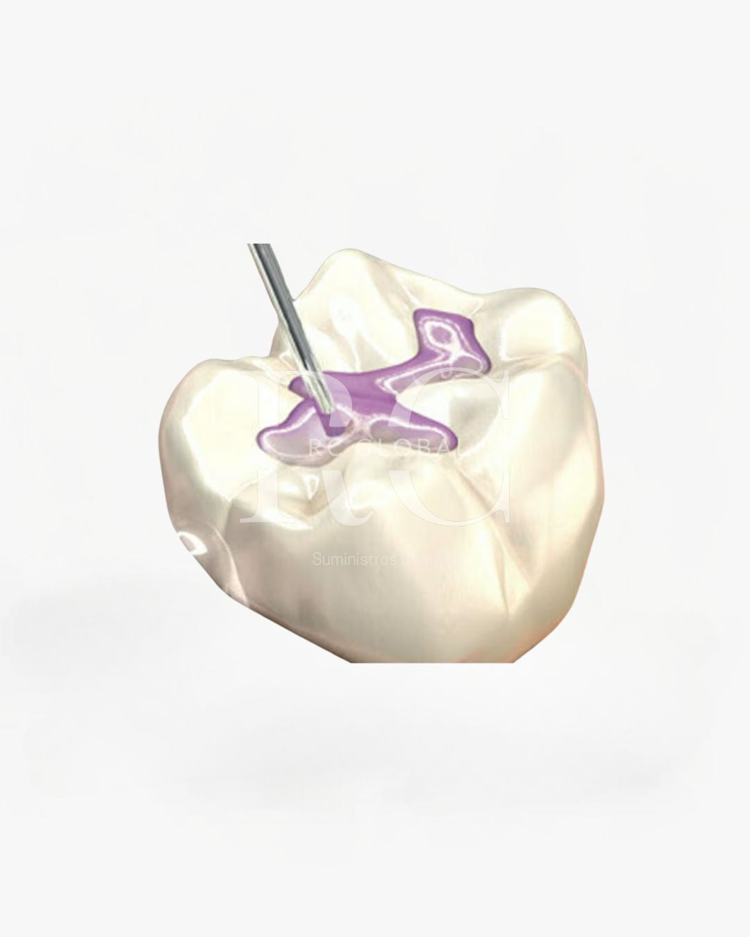 Sellador de Fosetas y Fisuras 3M™ Clinpro™ 12647 – Protección Duradera con Flúor Activo