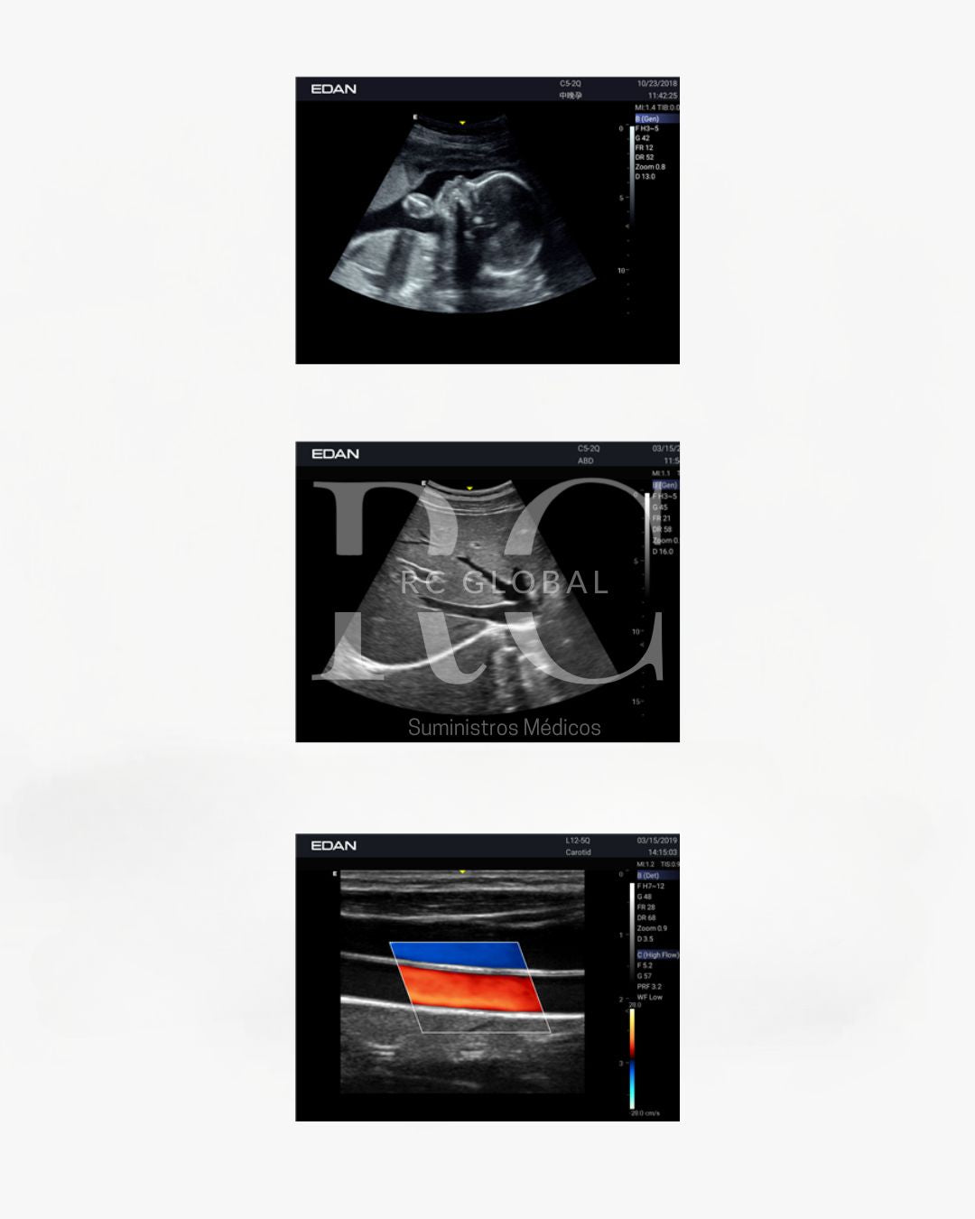 Dispositivo de ecografía Doppler color - EDAN Acclarix LX25